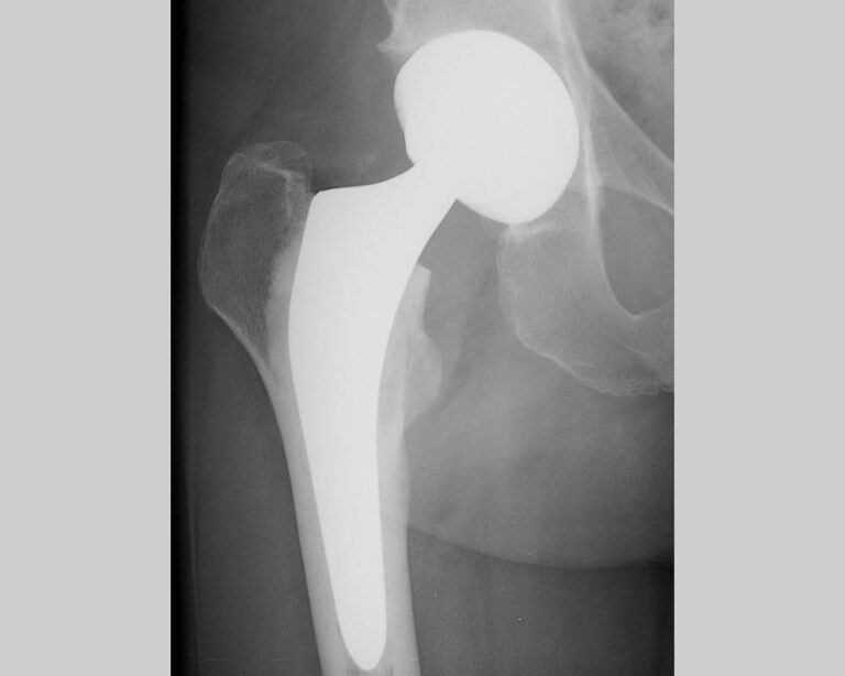 Minimally Invasive Anterior Approach Total Hip Replacement Doctor