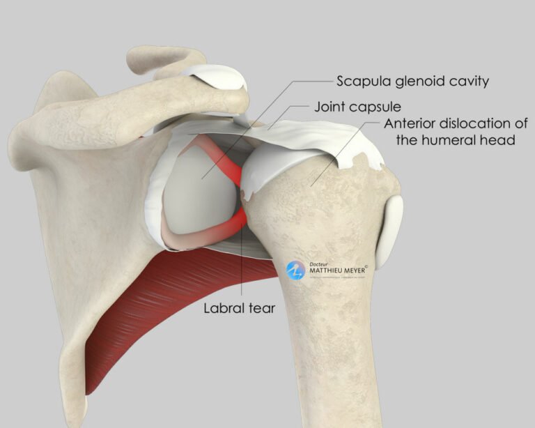 Arthroscopic Capsulolabral Repair (Bankart Procedure) Doctor Matthieu