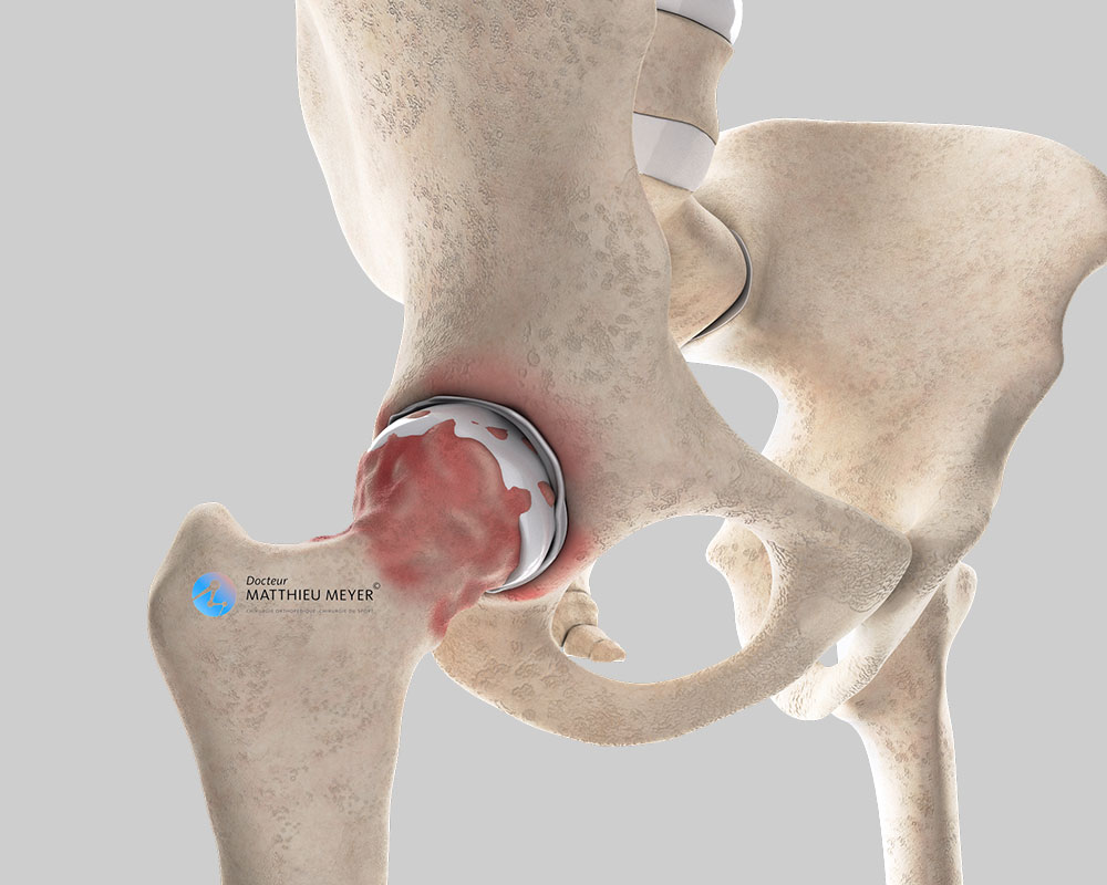 Hip osteoarthritis: wear of the cartilage