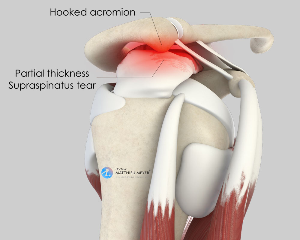 Arthroscopic Shoulder Acromioplasty Doctor Matthieu Meyer