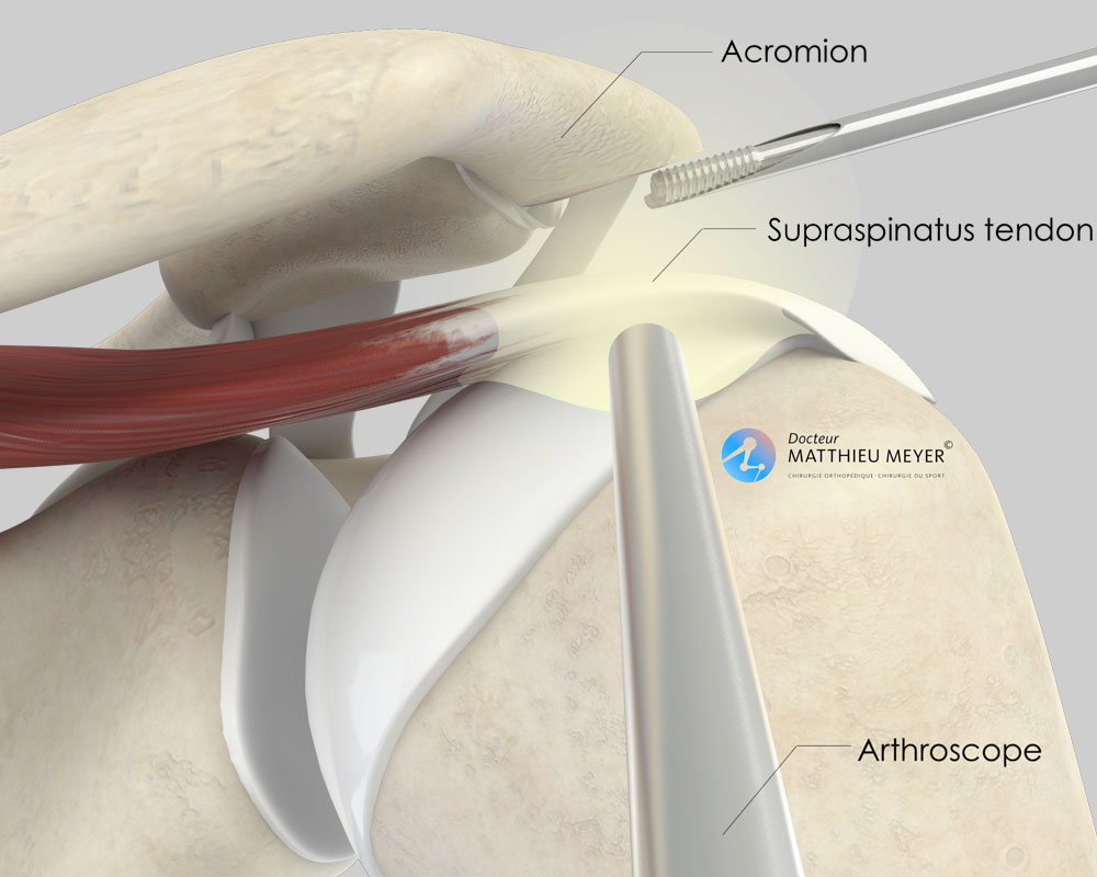 Arthroscopic acromioplasty (posterior view)