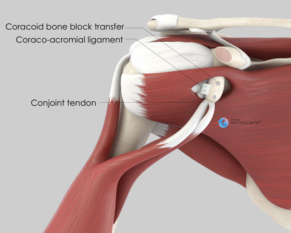 Coracoid bone block (frontal view)