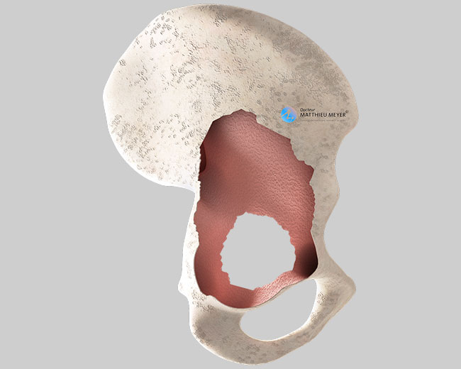 Destruction of pelvic bone after removal of the acetabular implant