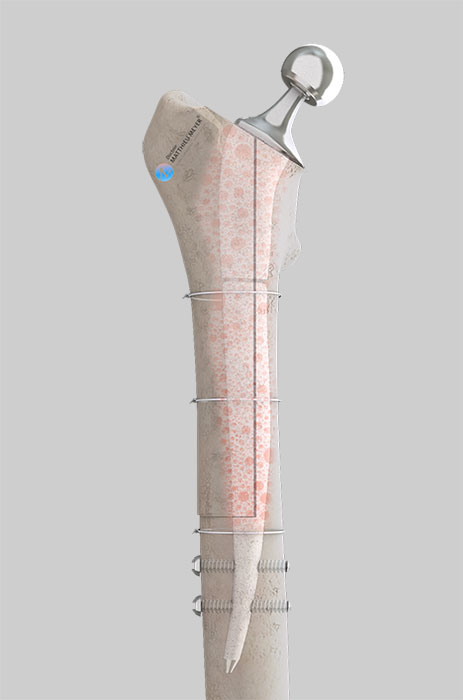 Reconstruction prosthesis with femoral osteotomy