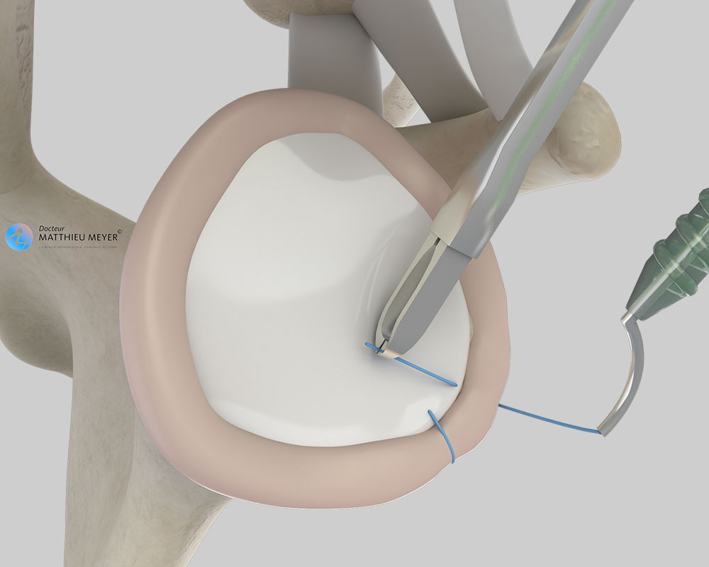 Arthroscopic reinsertion of the labrum (side view)