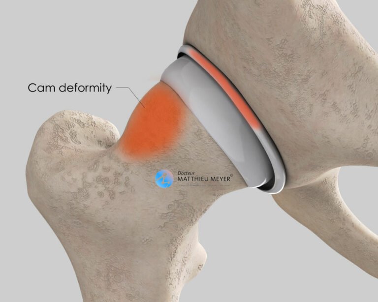 Anterior Hip Impingement Arthroscopy Doctor Matthieu Meyer