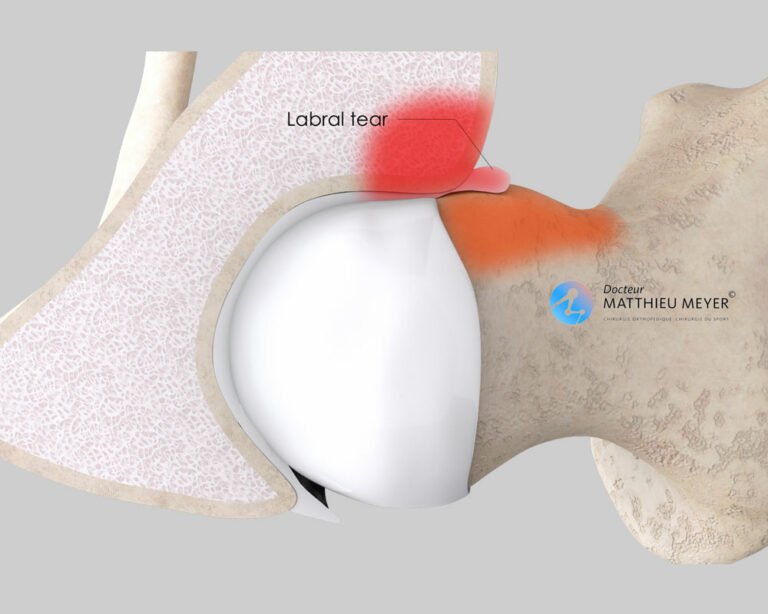 Anterior Hip Impingement Arthroscopy Doctor Matthieu Meyer