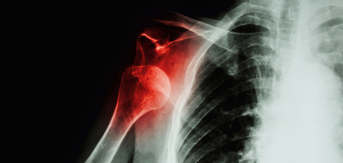 Unstable Shoulder Doctor Matthieu Meyer