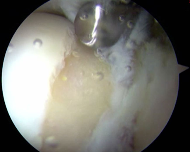 Arthroscopic view after trimming cam