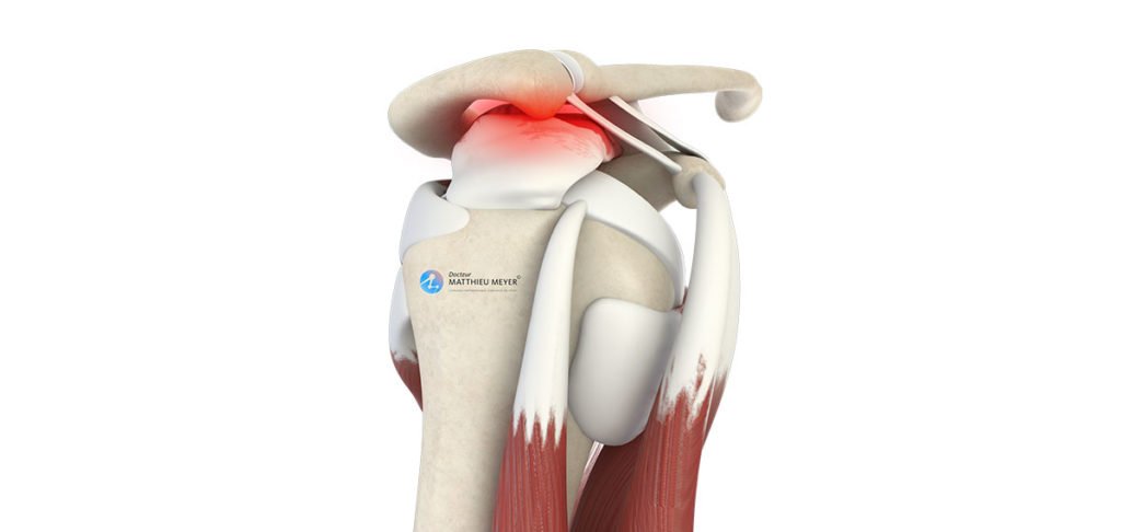 Acromioplastie de l'épaule