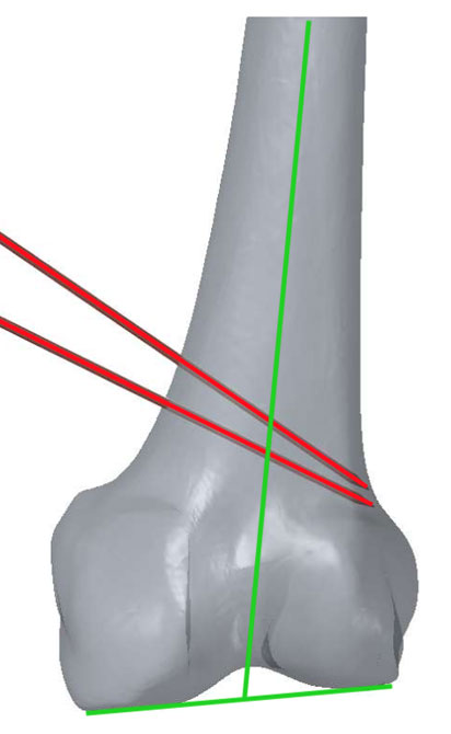 Planning osteotomy lines (in red)