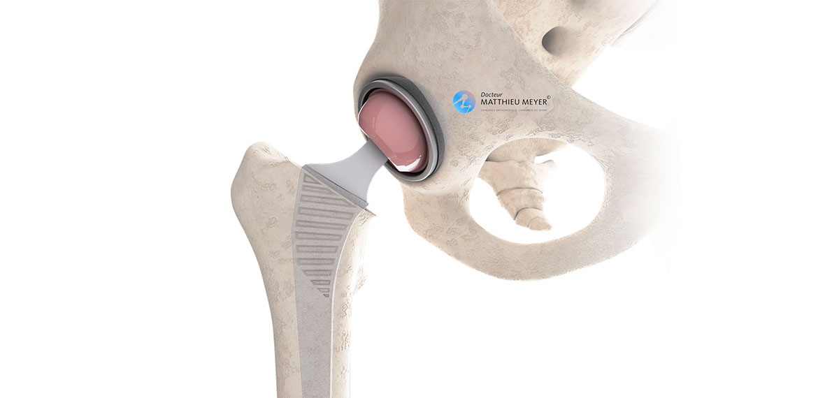 Return To Sports Activities After A Hip Replacement Doctor Matthieu Meyer