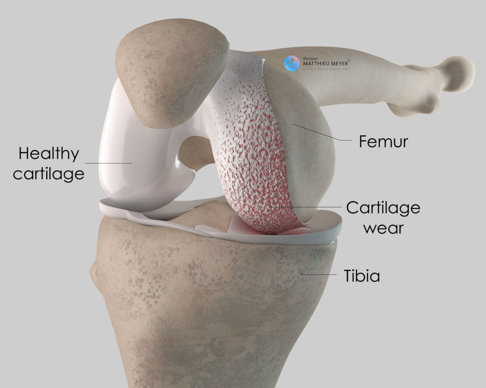Osteoarthritis of the medial femorotibial compartment