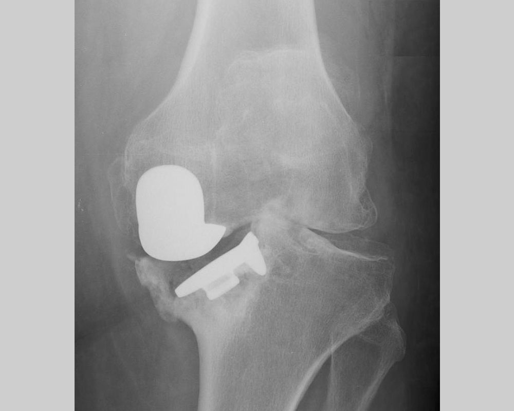 Loosening of a partial knee replacement with sinking and tilting of the tibial implant