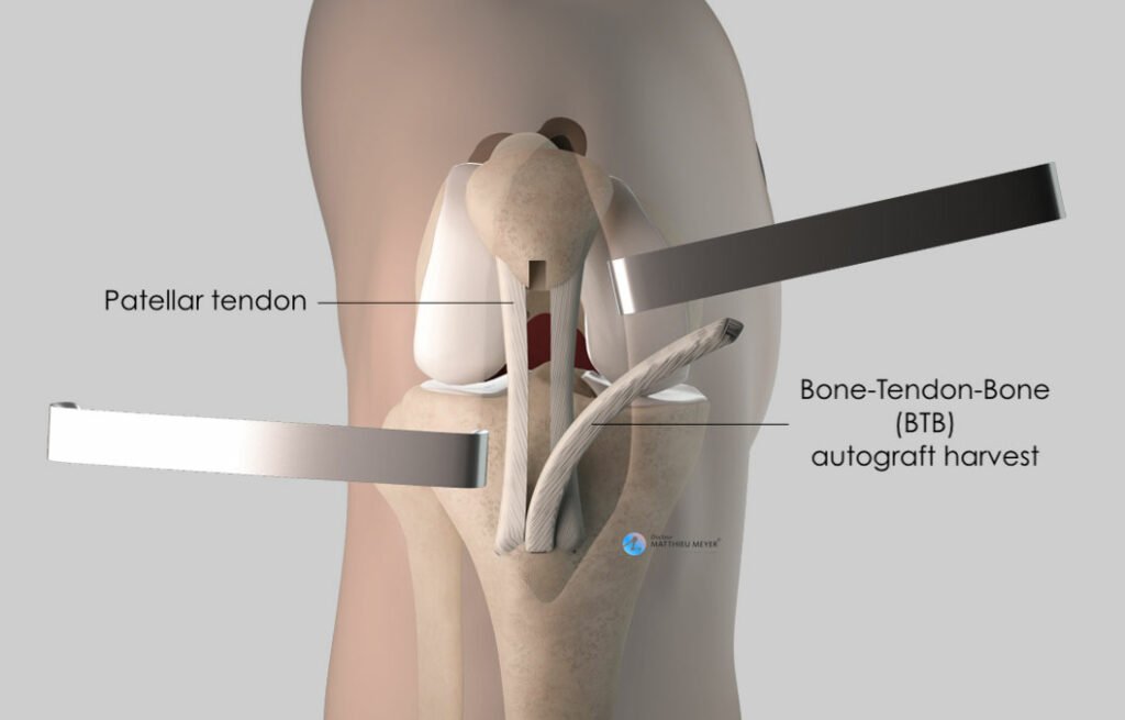 Harvesting of bone-tendon-bone graft