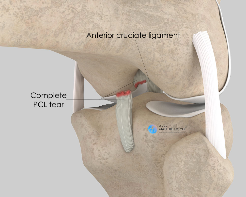 Posterior Cruciate Ligaments Injuries (PCL)