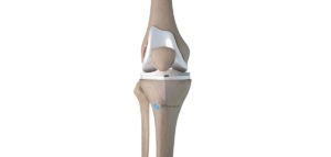 Prothèse totale de genou