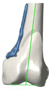 Medial Closing-Wedge Distal Femoral Osteotomy - Doctor Matthieu Meyer