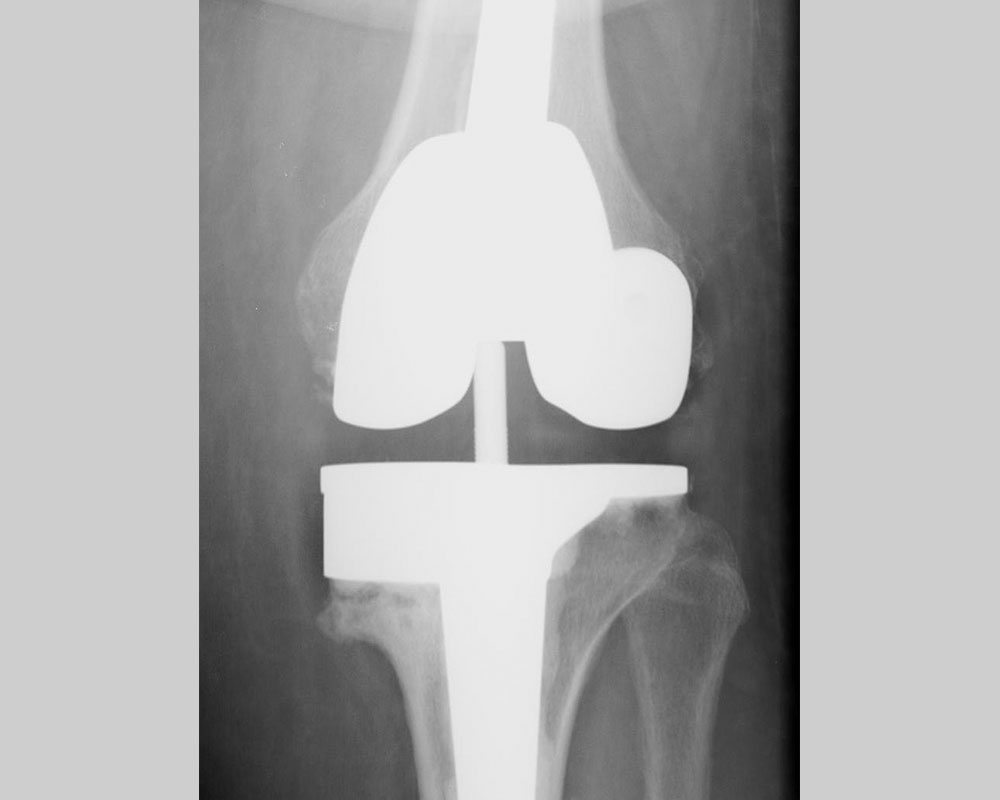 After replacement with a total knee prosthesis