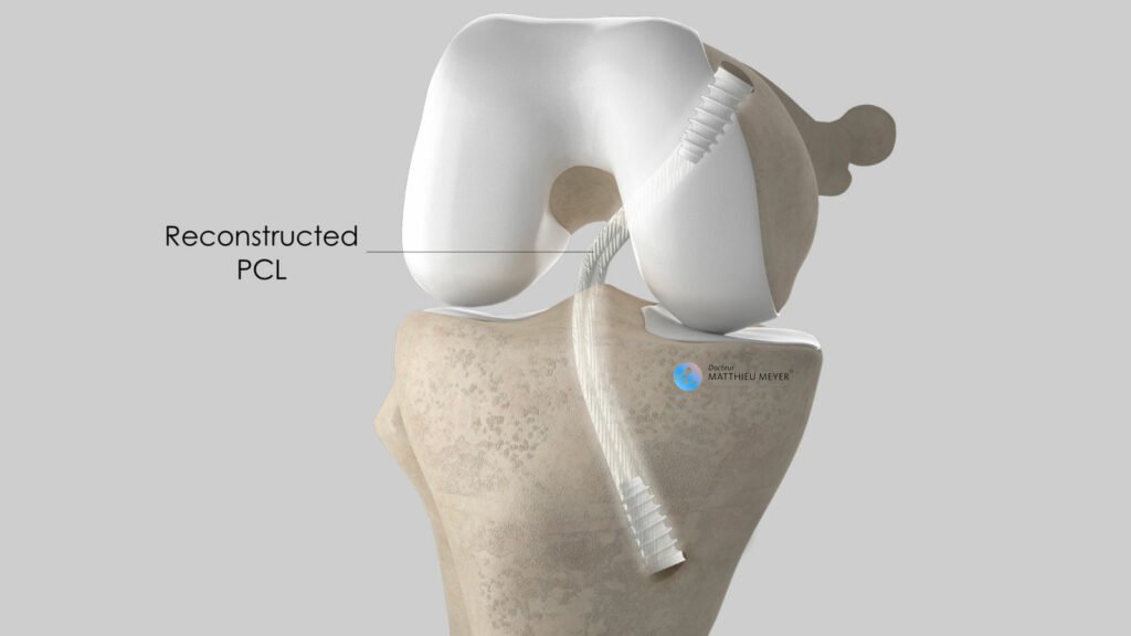 PCL reconstruction: final appearance with graft fixed in place using interference screws