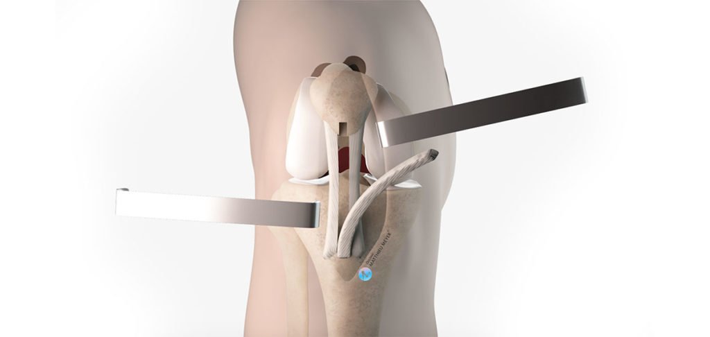 Ligamentoplastie du ligament croisé antérieur - Kenneth-Jones