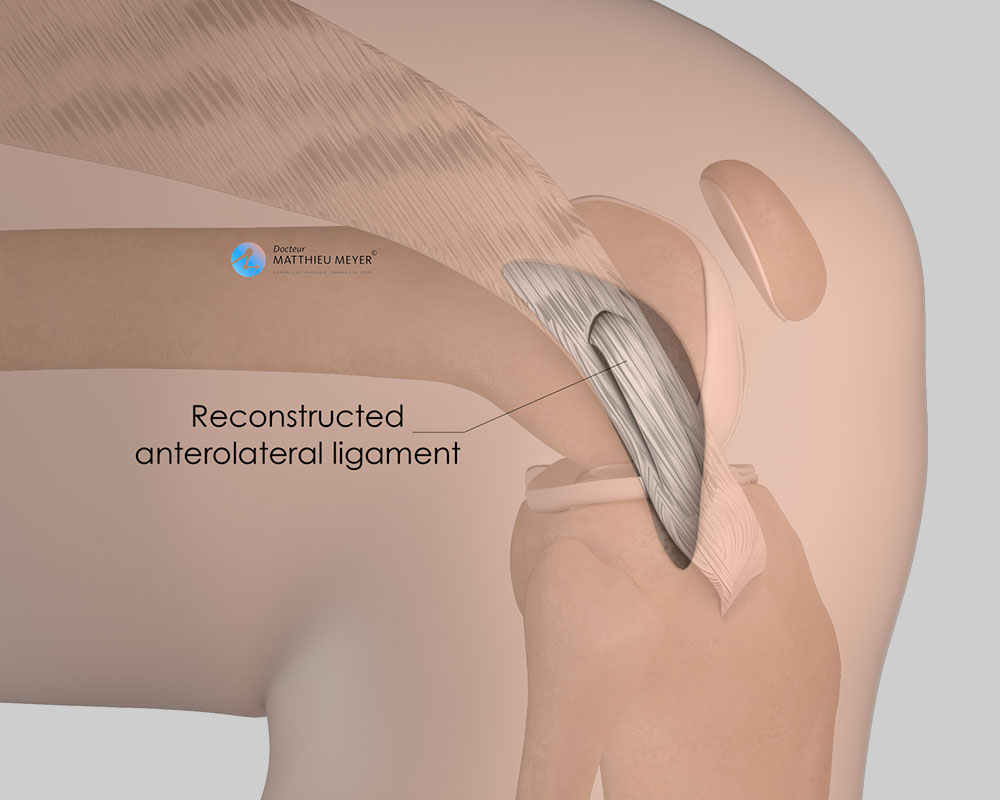 Reconstruction of the anterolateral ligament: final appearance