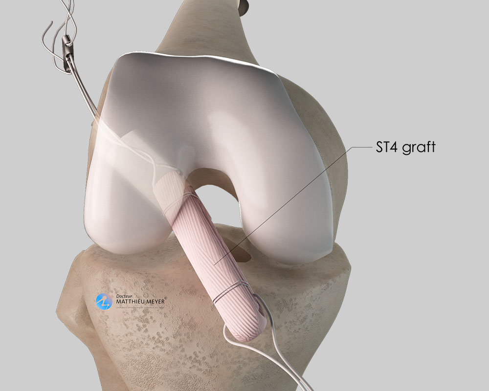 Positioning of the tendon graft