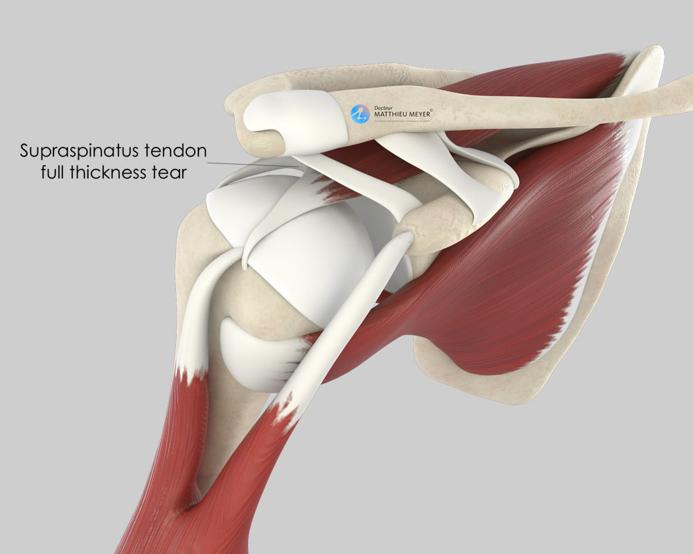 Rotator Cuff Repair (Mini-Open, Supraspinatus Tendon-to-Bone Insertion)