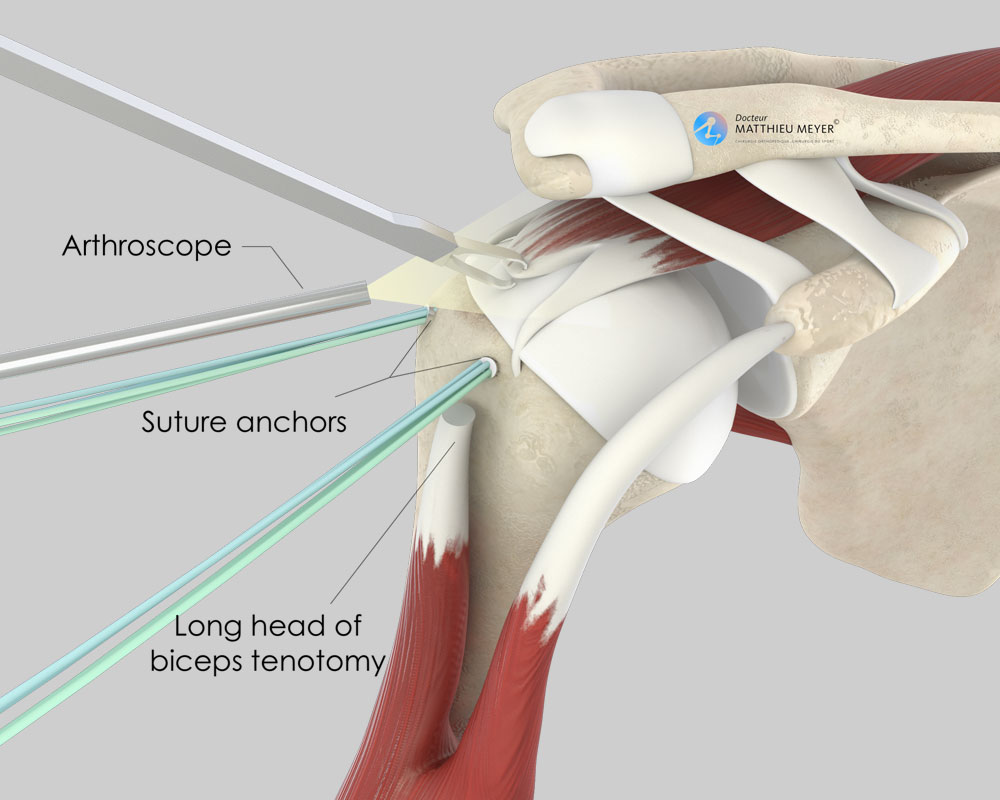 Rotator Cuff Repair Diagram