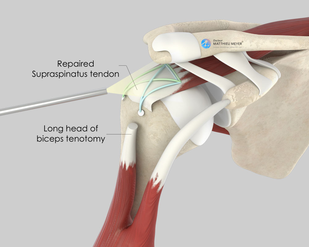 Arthroscopic Rotator Cuff Repair and Bicep Tenodesis: Right