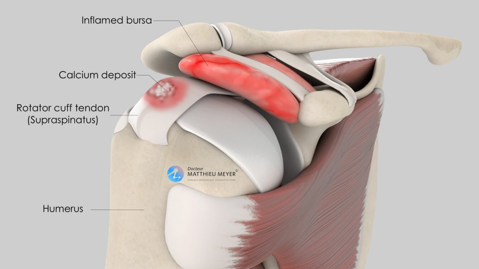 Arthroscopic Removal of Rotator Cuff Calcium Deposits Doctor Matthieu Meyer