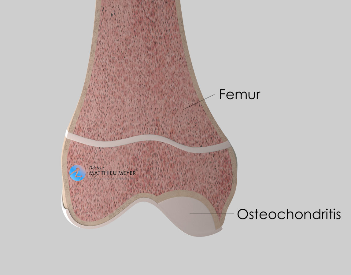 osteochondritis dissecans stages az ágyéki íves ízületek artrózisa