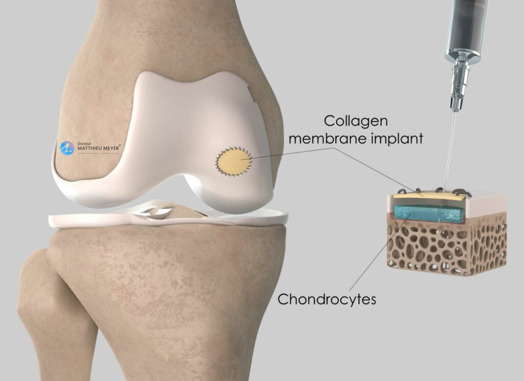 Drilling, Fixation And Osteochrondral Grafts Doctor Matthieu Meyer