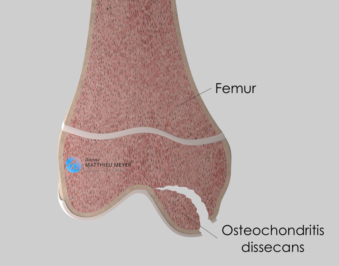osteochondritis dissecans stages