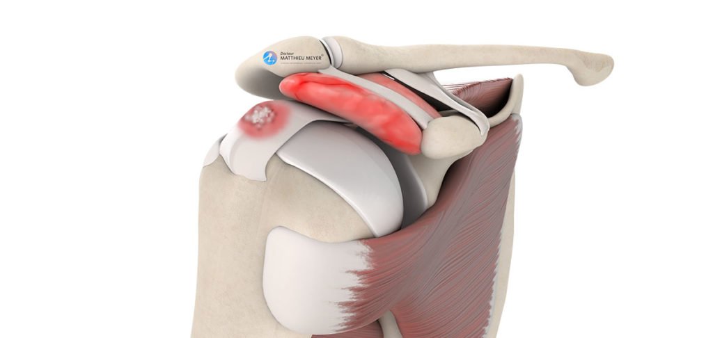 Evacuation de calcification de la coiffe des rotateurs par arthroscopie