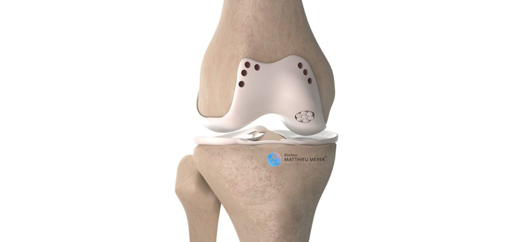 Perforations, refixations et greffes ostéochondrales