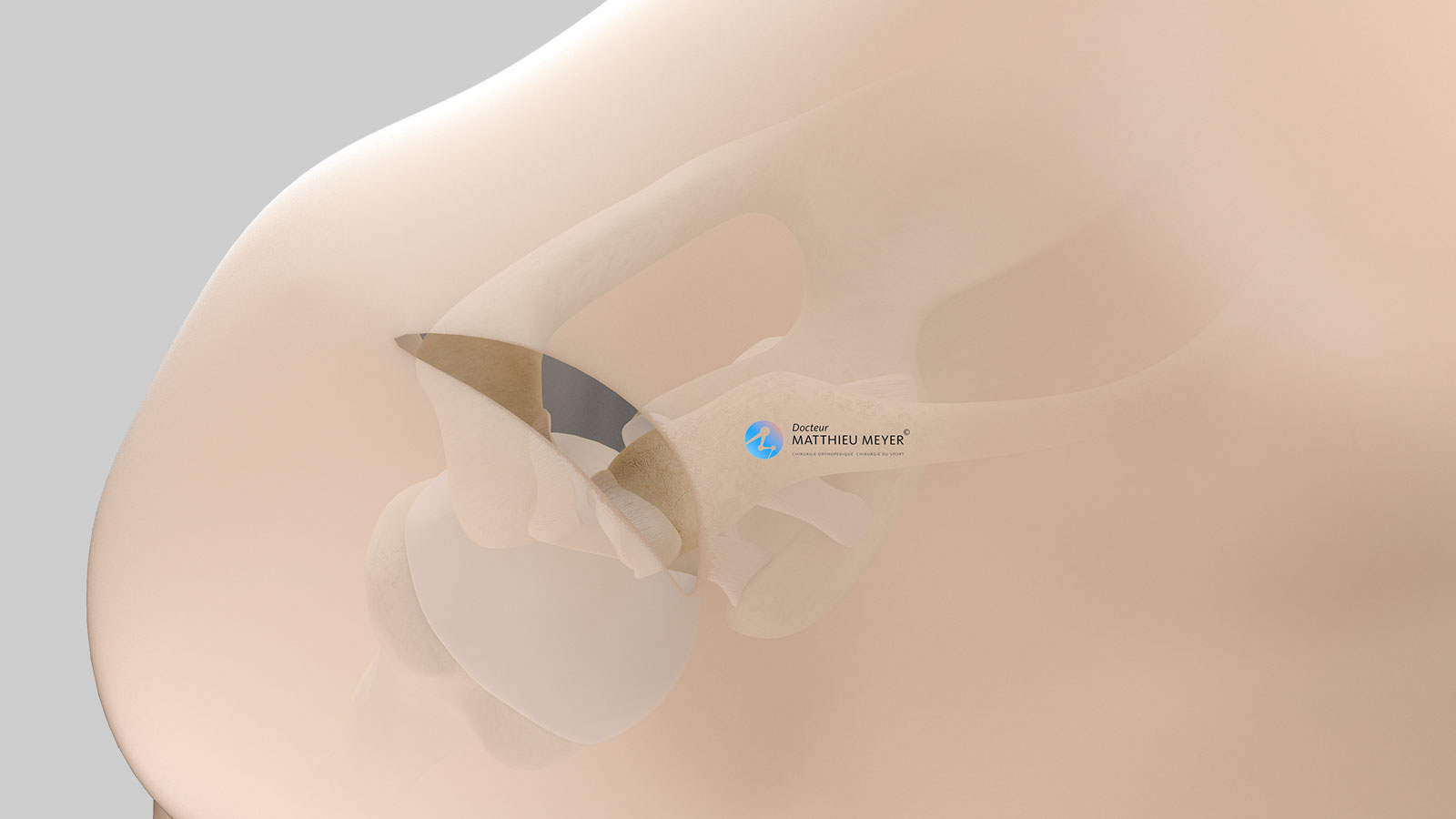 Incision on the superior side of the shoulder