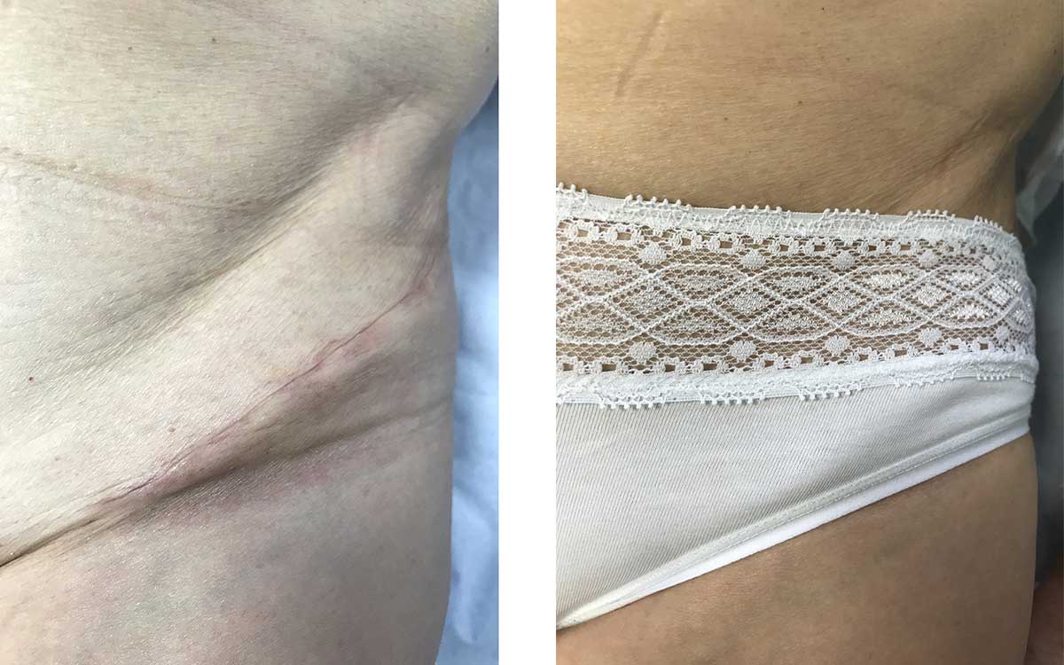 Bikini incision