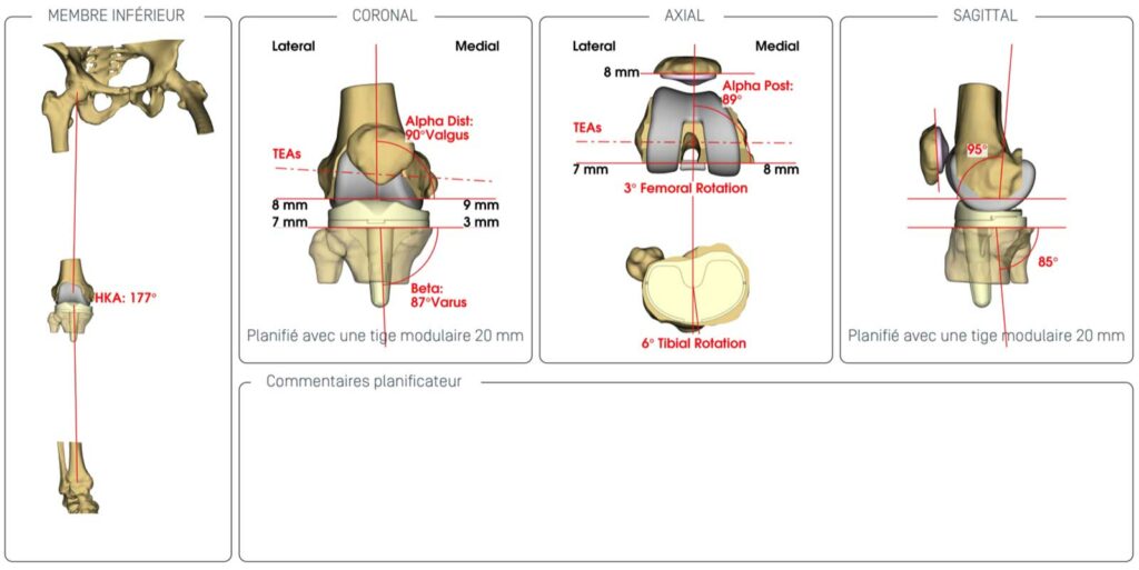 CUSTOM-MADE TOTAL KNEE PROSTHESIS WITH 3D CT-SCAN PLANNING